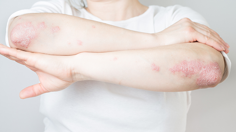 Tronco de mulher, vestida com t-shirt de manga curta branca, de braços cruzados, mostrando a zona dos cotovelos com manchas vermelhas e descamação de psoríase